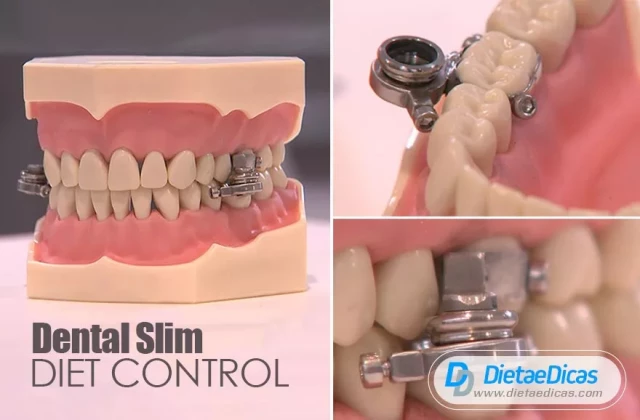 dentalslim diet control
