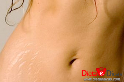 Ilustração de tratamentos contra estrias, tipos de tratamentos para estrias, tratamento com peeling para estrias, tratamento com microdermoabrasão para estrias, tratamento com intradermoterapia para estrias, tratamento com hidroxiapatita com metilcelulose para estrias